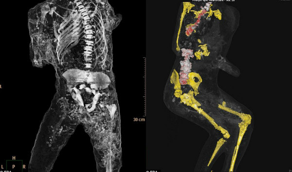 Η σπονδυλική στήλη, τα νεφρά και τα πλευρά ενός ανήλικα άντρα φάνηκαν ξεκάθαρα μέσω της σάρωσης. Ακόμα και η στάση του σώματος.