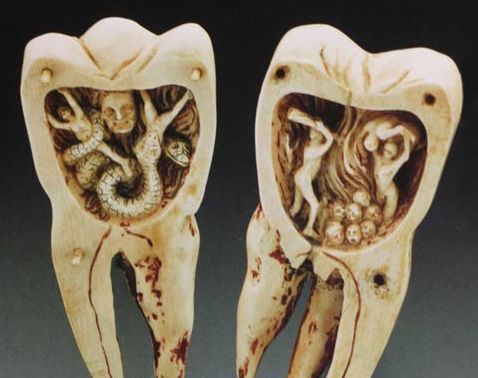 Οι Σουμέριοι πίστευαν ότι σκουλήκια εισχωρούσαν στο εσωτερικό των δοντιών και τα κατέστρεφαν 