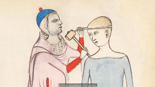 Απεικόνιση τρυπανισμού στον 14ο αιώνα