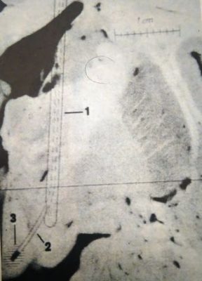 Ακτινογραφία του εγκεφάλου με καθετήρα και ηλεκτρόδιο που εισάγει το ηλεκτρικό ρεύμα στο σεξουαλικό κέντρο 